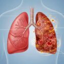 Pneumonia